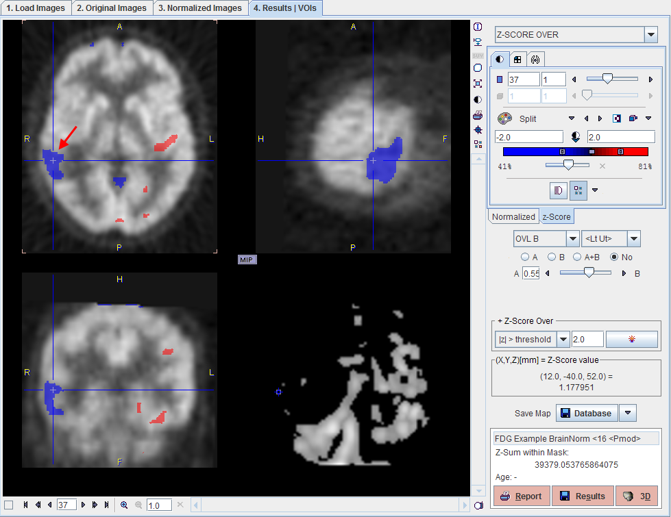 BrainDB Example Result